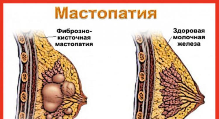 Особенности развития и лечения диффузной фиброзно-кистозной мастопатии